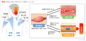 肩こりと高血圧 | さいとう内科・循環器クリニック