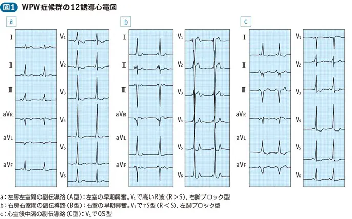 Wpw症候群 Wolff Parkinson White Syndrome さいとう内科 循環器クリニック