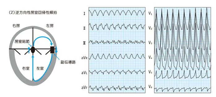 WPW症候群（Wolff-Parkinson-White syndrome） | さいとう内科・循環器クリニック