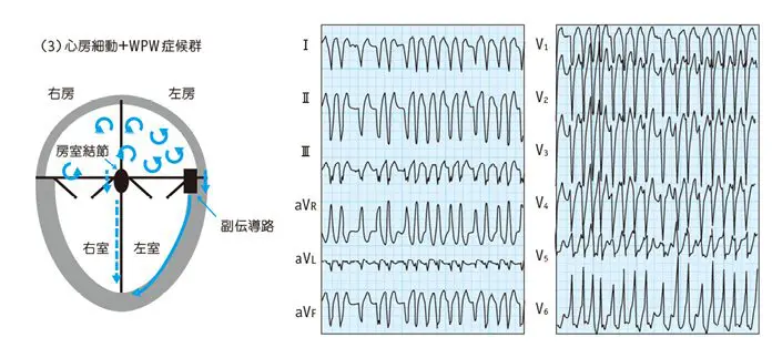 Wpw症候群 Wolff Parkinson White Syndrome さいとう内科 循環器クリニック